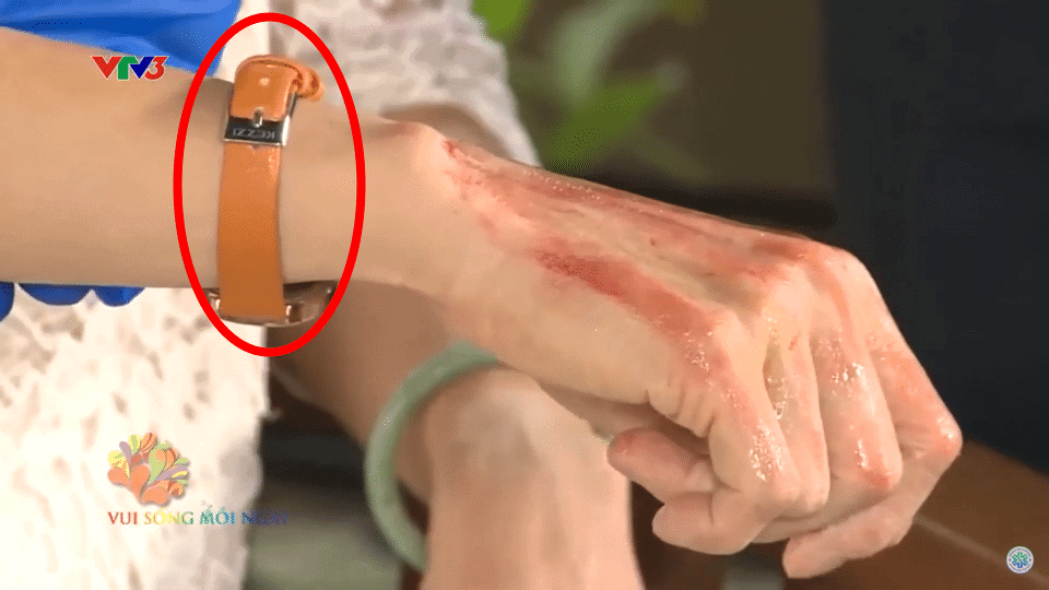 First aid when a child is burned