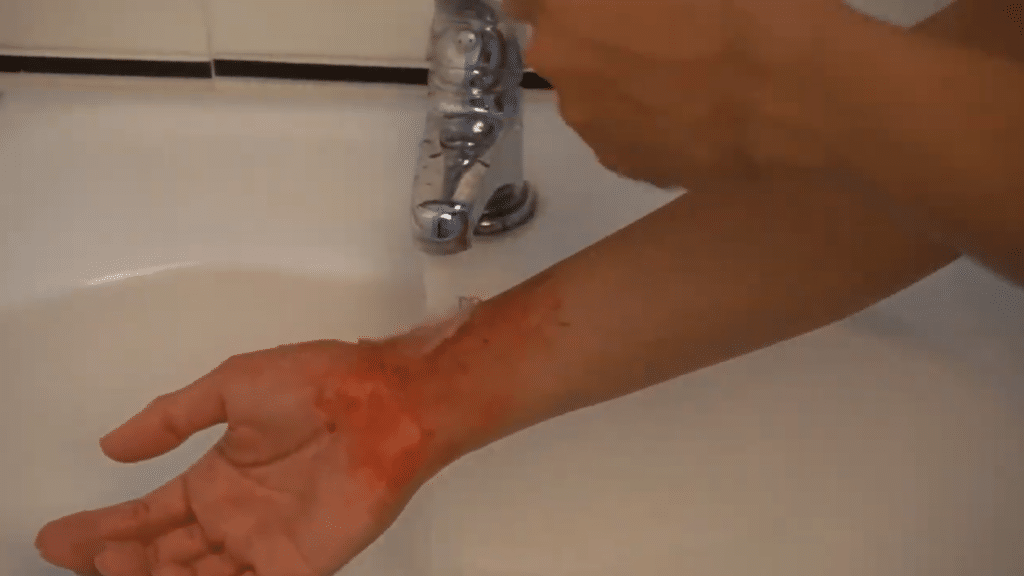 First aid when a child is burned