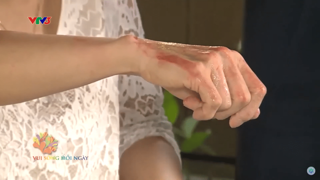 First aid when a child is burned