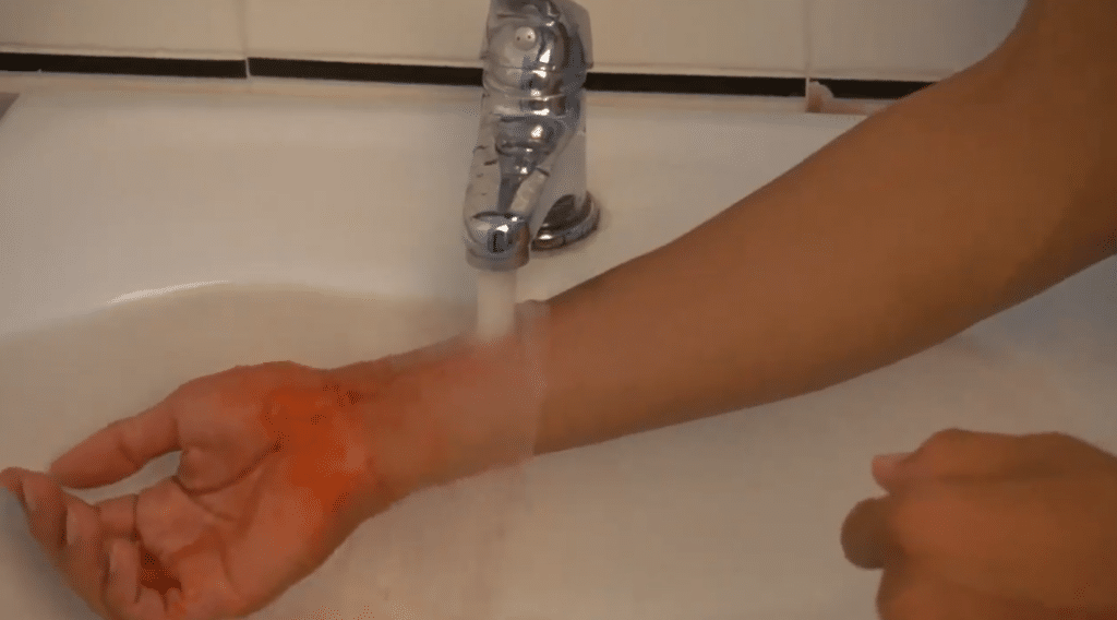 First aid when a child is burned