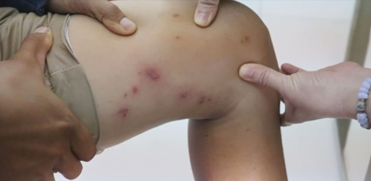 How to properly handle rove beetles' stings ?