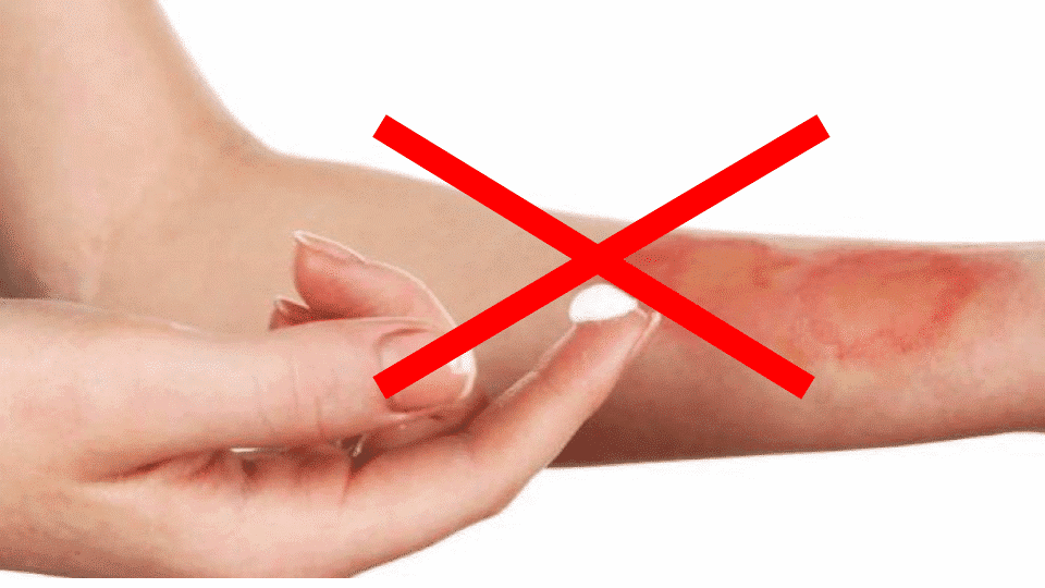 First aid when a child is burned