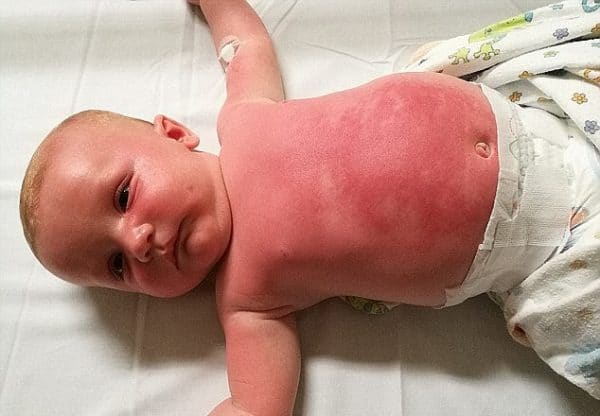 cách sơ cứu trẻ bị bỏng